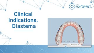 Clinical Indications Diastema [upl. by Ijies]