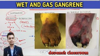 general Pathology  wet and gas gangrene  Hindi [upl. by Eberly]