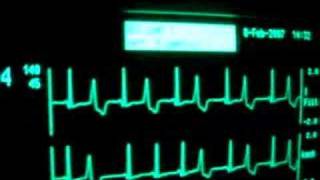 intensive care ecg with extrasystoles [upl. by Adle]