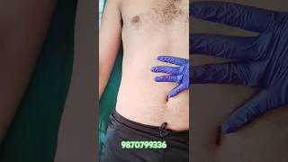 Navel displacement by drdeepanshi physiotherapist youtube shorts reels viral [upl. by Yessej311]