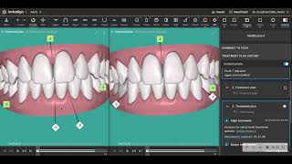 Spacing and gap between teeth is often tooth SHAPE and not tooth POSITION [upl. by Gardas308]