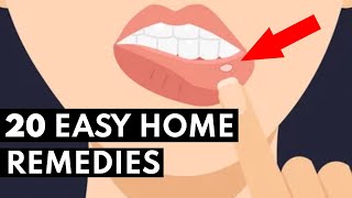 How To Get Rid Of Canker Sores FAST [upl. by Nylyak]