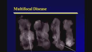 Breast Cancer Staging with Ultrasound [upl. by Aihsenrad687]