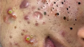 Big Cystic Acne Blackheads Extraction Blackheads amp Milia Whiteheads Removal Pimple Popping  6833 [upl. by Eerak]