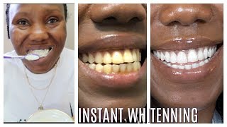 How I whitened my yellow teeth in 2 Minutes  LIVE DEMO HOME REMEDY [upl. by Friederike339]