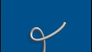 alpha loop in colonoscopy [upl. by Eak]