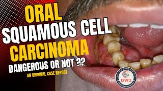 ORAL SQUAMOUS CELL CARCINOMA  HOW DANGEROUS OR LEATHAL IS IT  AN ORIGINAL CASE REPORT PART 1 [upl. by Sparhawk]