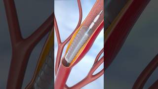 Coronary Angioplasty and Stent Insertion coronary angioplasty [upl. by Tingey]