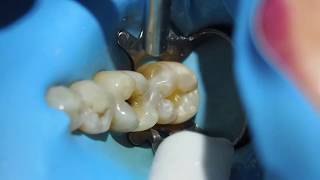 Posterior composite resin restoration Dr Lincoln Harris [upl. by Xenia]