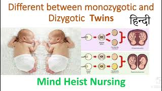 different between Monozygotic ampDizygotic twins Midwifery ampGynecology Explained in Hindi [upl. by Assenat913]