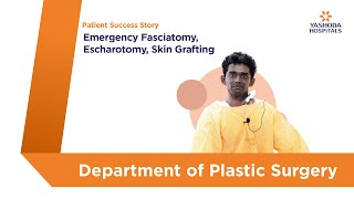 Emergency Fasciotomy Escharotomy Skin Grafting  Yashoda Hospitals Hyderabad [upl. by Nirol]