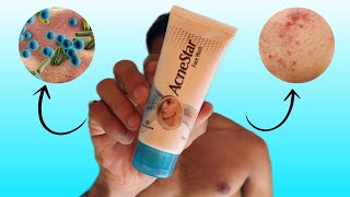 Acnestar face wash review  kya acnestar soap se behtar hai [upl. by Lipinski46]