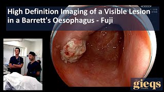 High Definition Imaging of a Visible Lesion in a Barretts Oesophagus [upl. by Corie]