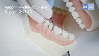 How to use Gracey 1314 SD LM™ hand instrument [upl. by Reffinnej]