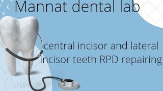 central incisor and lateral incisor teeth RPD repairing [upl. by Nich]