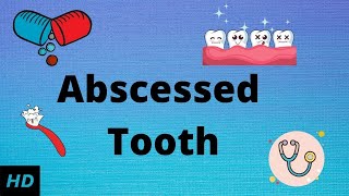 Abscessed tooth Causes SIgns and Symptoms Diagnosis and Treatment [upl. by Milde]