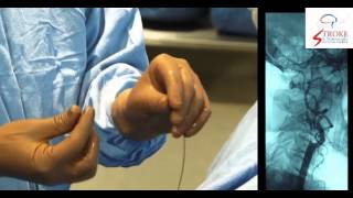 Live Carotid Artery Stenting [upl. by Inobe290]