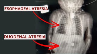 Esophageal Atresia amp Duodenal Atresia Qida borusu və Onikibarmaq bağırsaq Atreziyası [upl. by Dominick]