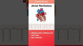 Atrial Fibrillation Anatomy ECG icu medicine emergencymedicine atrialfibrillation [upl. by Lrae]