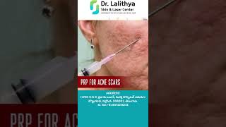 PRP Treatment Acne Scars  Motimalu  Dr Lalithya Kadimi  Dr Lalithya Derma Nalgonda [upl. by Annaillil]