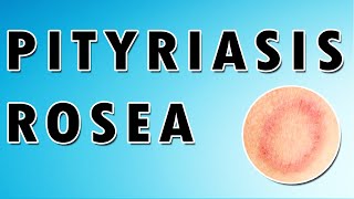 Pityriasis Rosea Symptoms Treatment and Causes [upl. by Carmita429]