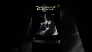 Vegetation at Mitral Valve echo shorts shortsvideo heartcondition [upl. by Manville]