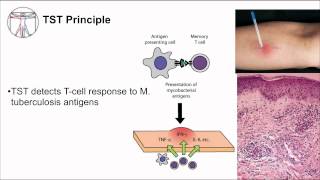 Tuberculosis Diagnosis [upl. by Criswell]