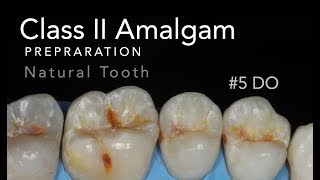 Class II Amalgam Preparation  5 DO Natural Tooth [upl. by Cohbert133]