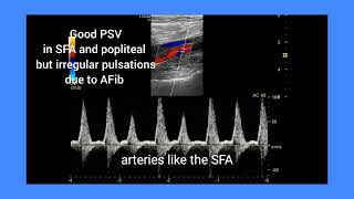 Peripheral artery disease PAD with atrial fibrillation ultrasound color and spectral Doppler [upl. by Ecirtra]