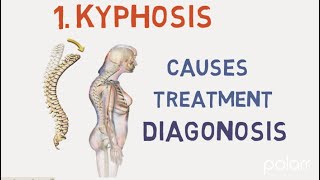 Kyphosis  Overview Causes Symptoms Treatment Diagnosis And Prevention  All in 2 min [upl. by Coppock]