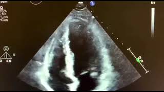 Echocardiography of patient with Mitral annular disjunction MAD [upl. by Silver871]