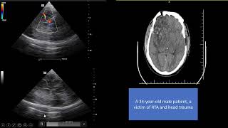 POCUS in Clinics 5 role of advanced critical care US in management of comatose patient [upl. by Ahsinert4]