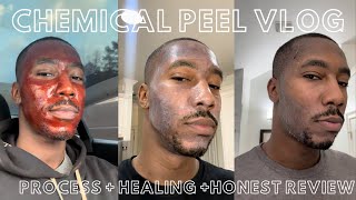 I tried the MelanX Chemical Peel and heres how it went  SIXSIXPAPI [upl. by Eirelav]