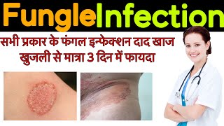 Fungle infection  Fungle infection treatment symptoms  precaution [upl. by Ardnot711]