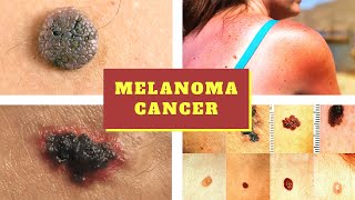 Melanoma Symptoms  Causes Pictures Stages Signs and Symptoms of Melanoma Skin Cancer Tumor [upl. by Graff489]