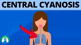 Central Cyanosis Medical Definition  Quick Explainer Video [upl. by Oiramed]