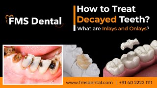 How to Treat Decayed Teeth What are Inlays and Onlays by FMS Dental [upl. by Arihsak]