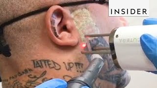 Eliminación de Tatuajes  Insider Español [upl. by Arimihc477]