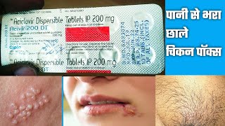 Acivir 200 DT Tablet  Aciclovir 200mg Tablet  Acivir 200mg DT Tablet मुंह के ऊपर छाले बदन पे छाले [upl. by Nosittam588]