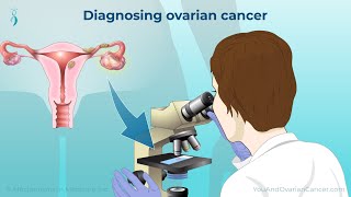 Diagnosing Ovarian Cancer [upl. by Ahsiekat293]