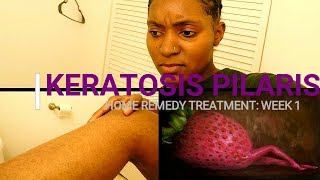 HOW TO REMOVE KERATOSIS PILARIS Week 1 Home Remedy Treatment [upl. by Hart]