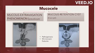 MUCOCELEMUCOUS EXTRAVASATIONSUPERFICIAL MUCOCELE imagebasedquestion bdshorts neetmds2023 [upl. by Claudina]