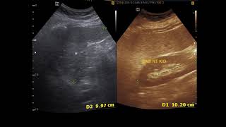 Ultrasound cases 361 of 2000  Utricle Cyst Splenic Cyst Hypoechoic nodule Breast Duct ectasia [upl. by Adham]