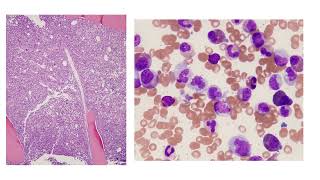 Dr Sanam Loghavi teaches how to confirm diagnosis after bone marrow biopsy [upl. by Yi]