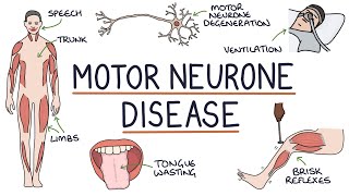 Understanding Motor Neurone Disease Amyotrophic Lateral Sclerosis [upl. by Enirtak]