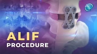 What is Anterior Lumbar Interbody Fusion  ALIF [upl. by Haroppiz943]