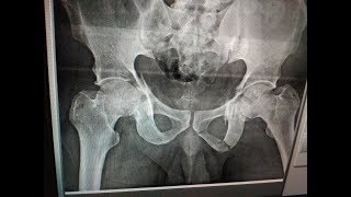 Acetabulum Percutaneous technique  Dr Ramprasad K MSORTHO AIIMS FAOA AUS A1 ORTHOCARE [upl. by Hsina138]