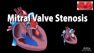 Mitral Valve Stenosis Animation [upl. by Evelc223]