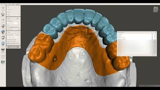 Full Arch Implant Provisional FP1 — Meshmixer [upl. by Arela]