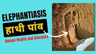 Elephantiasis Symptoms  Filariasis Class 12  Human Health and Diseases [upl. by Rankin151]